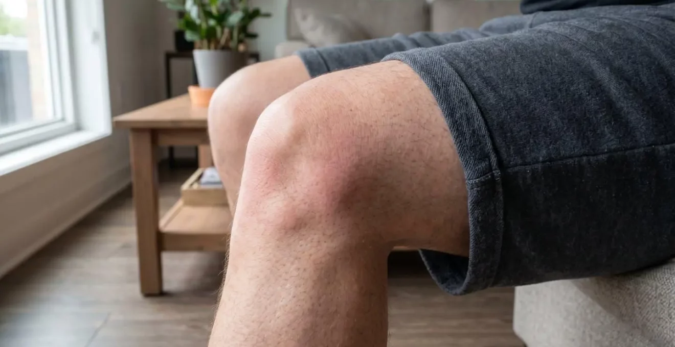 Gros plan sur un genou présentant un léger gonflement et une rougeur, signes caractéristiques d'une inflammation articulaire